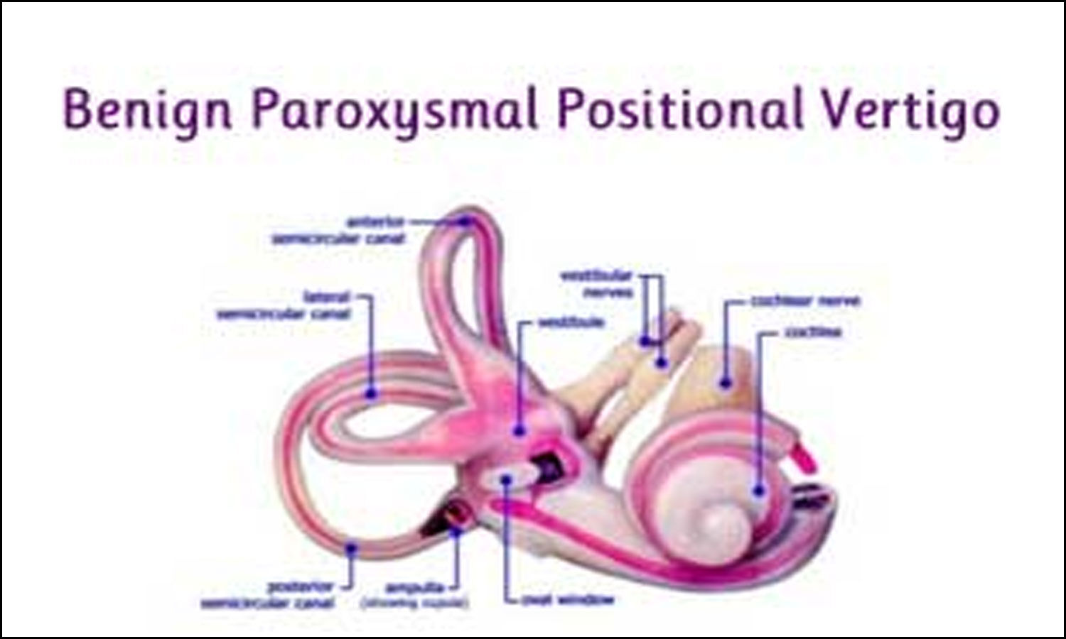 Benign Paroxysmal Positional Vertigo Bppv Symptoms And Causes