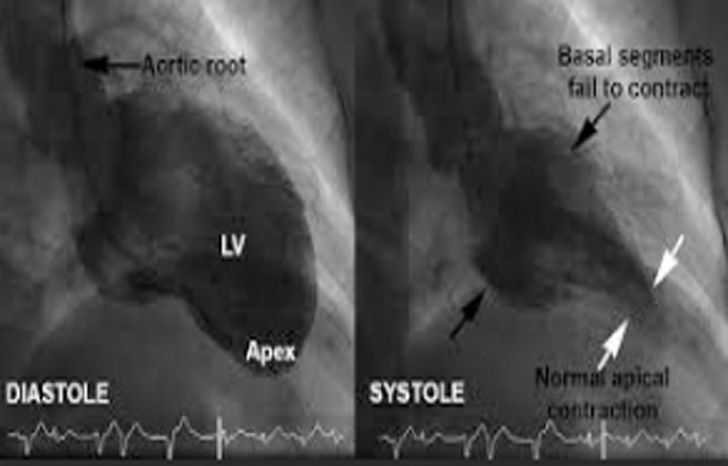 Case Of Reverse Takotsubo Cardiomyopathy Caused By Cryptogenic Stroke