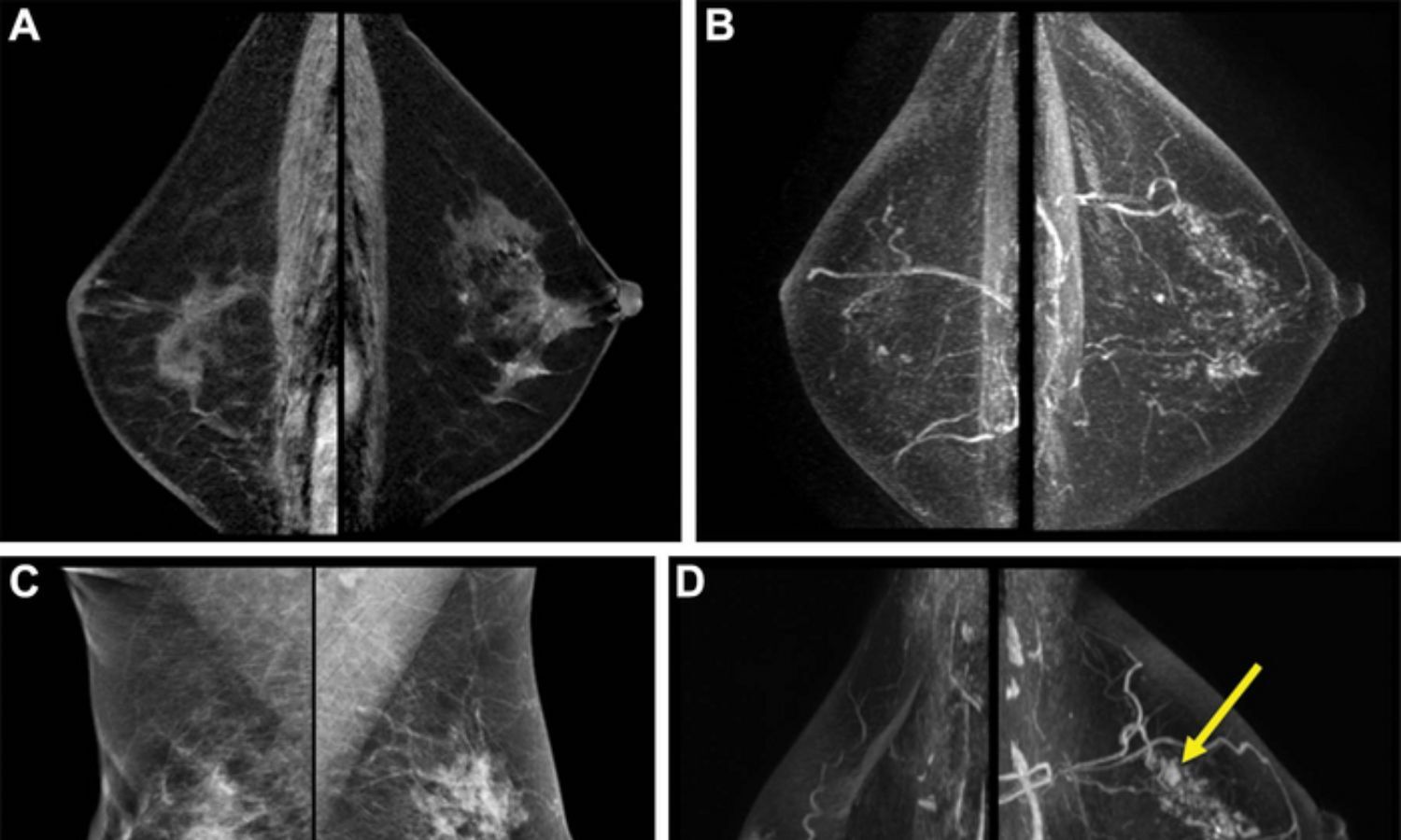 Breast Tissue Features On MRI May Illuminate Risk Of Second Breast Cancer