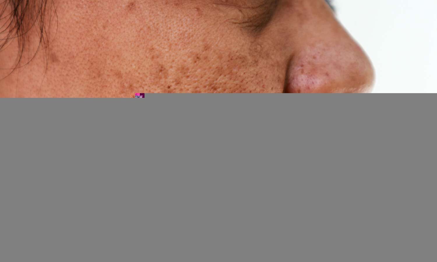 Picosecond Domain Laser Safe And Effective Adjunct Treatment Of Melasma