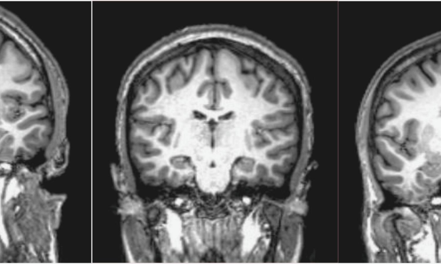 D Structural Brain Mri Using Deep Learning Exhibits Potential For