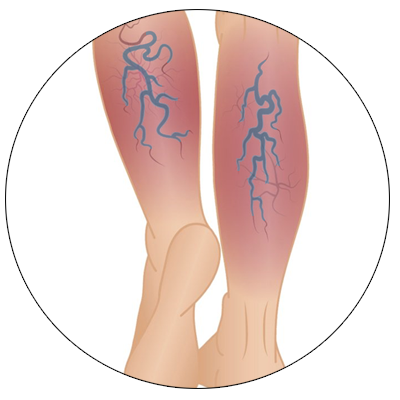 Chronic Venous Disease(CVD)