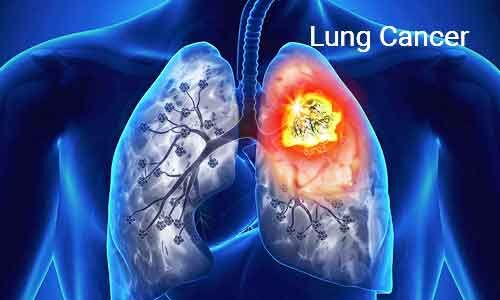 Low-dose CT for lung cancer screening offers more than benefit than harm