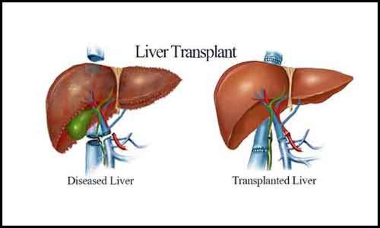 Study finds HCV-positive livers safe for transplantation