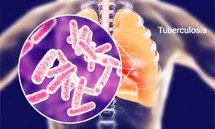 Four-month rifapentine regimen for TB equally effective as 6-month standard regimen: NEJM