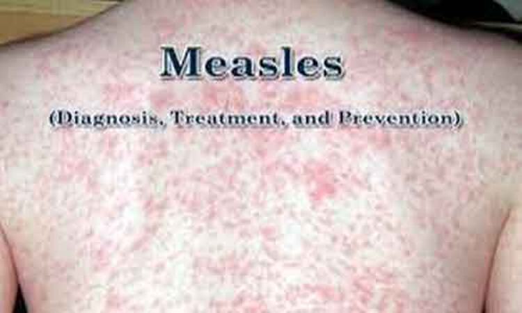 Diagnosis and Management of Measles: CDC Guideline
