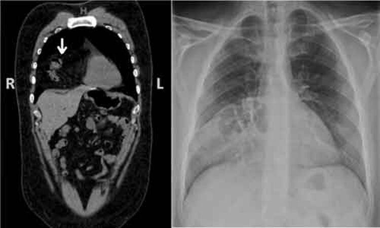 Rare case of congenital Morgagni hernia presenting with chest pain - a report