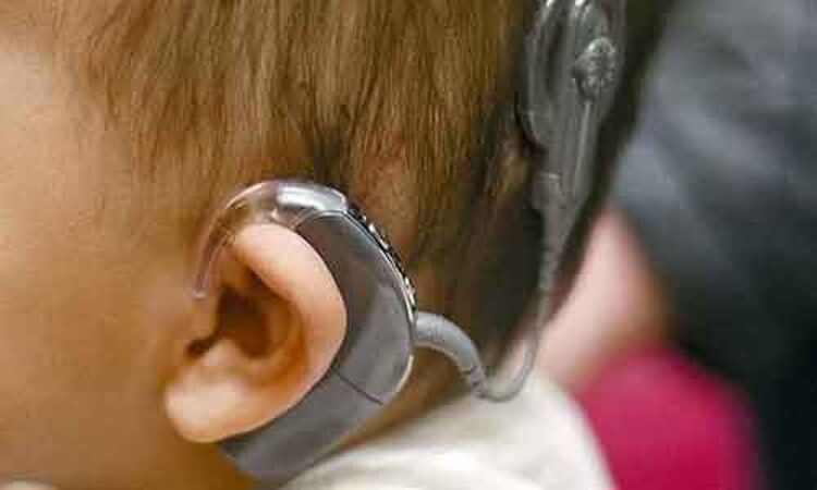 Benefits of early cochlear implantation in children outweigh risks: JAMA