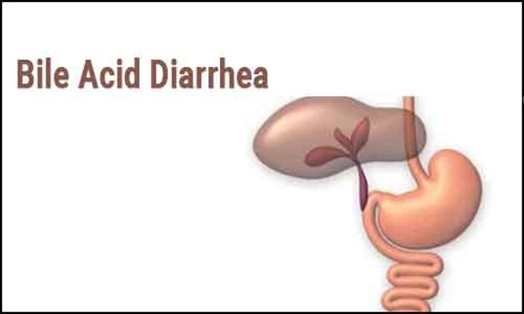 Liraglutide better than standard of care for bile acid diarrhea, small trial claims