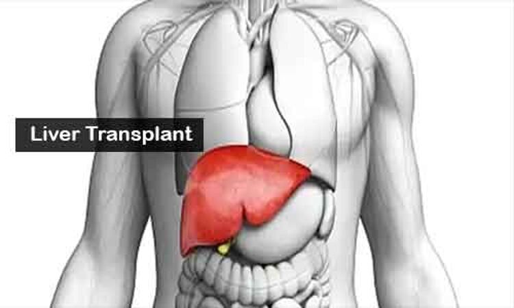 Frailty linked to higher mortality for women awaiting liver transplants