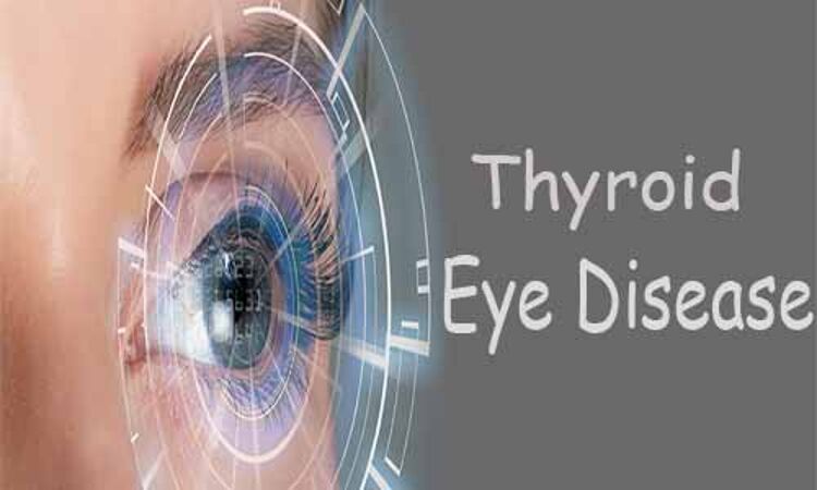 Moderate to severe Thyroid eye disease associated with increasing severity of proptosis/diplopia