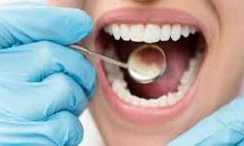 Toothpaste with Proteins, enzymes and Steareth 30 helps prevent gingivitis: Study