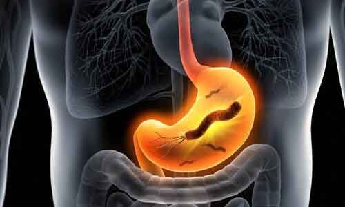 Are clarithromycin-based therapies ineffective for H. pylori infection? Study sheds light