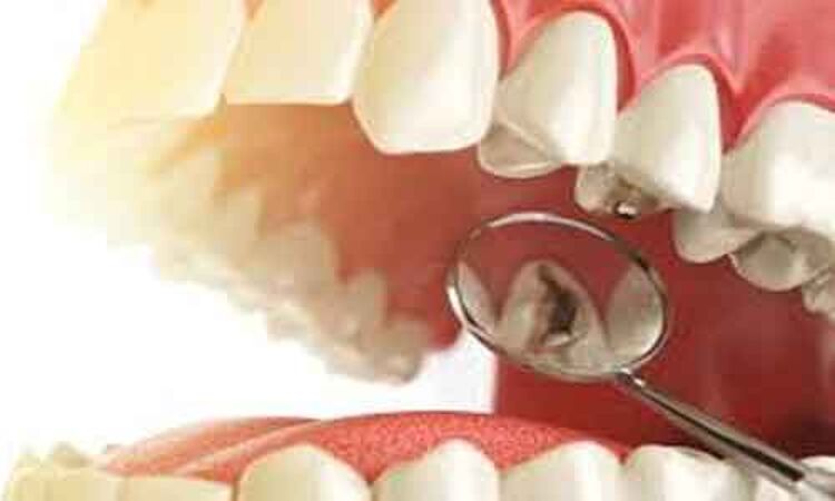 Number of missing teeth  strongest predictor of mortality: study