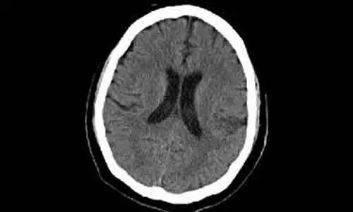 Abnormal brain MRI findings in infants with mild neonatal encephalopathy