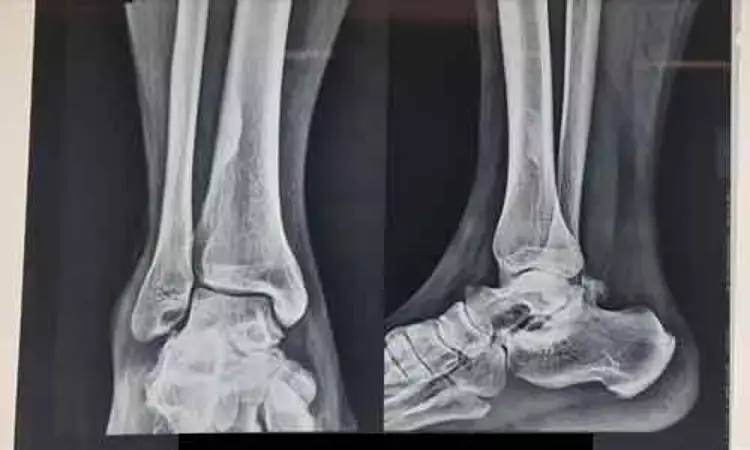Total ankle replacement better than ankle arthrodesis for severe ankle arthritis patients: Study