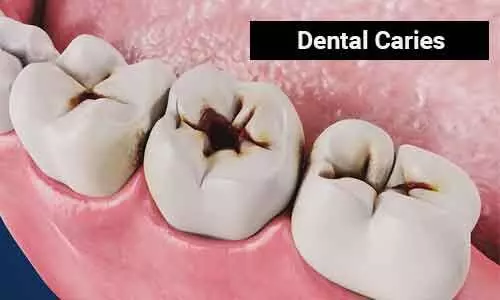 Dental caries concentrated among low-socio economic status individuals, finds Study