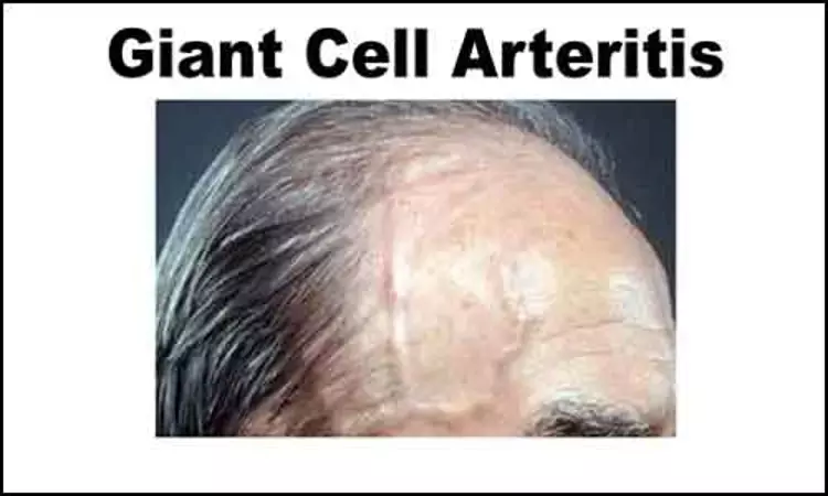 Factors That Can Help in Diagnosis of Giant Cell Arteritis, finds JAMA study