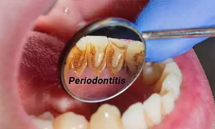 New Study Links Periodontitis and COVID-19 Complications
