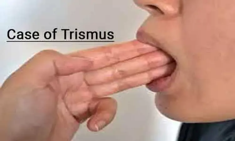 New Intraoral Appliance for Trismus in Oral Submucous Fibrosis- Case report