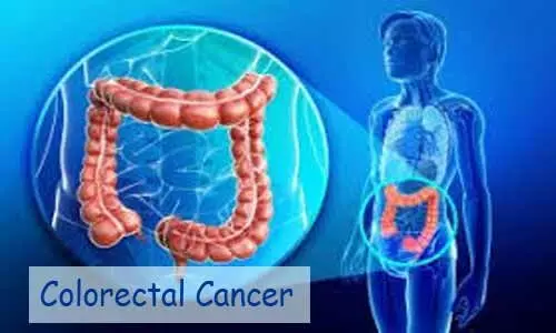 Lower exposure to UVB light may increase colorectal cancer risk
