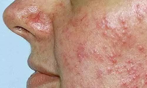 Case of Rosacea treated with light-emitting diodes