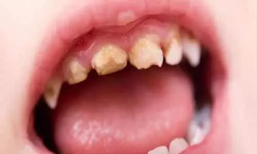 Stress in children linked to early eruption of molar teeth