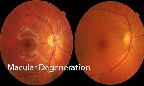 Areds 5-step Simplified Severity Scale For Macular Degeneration 