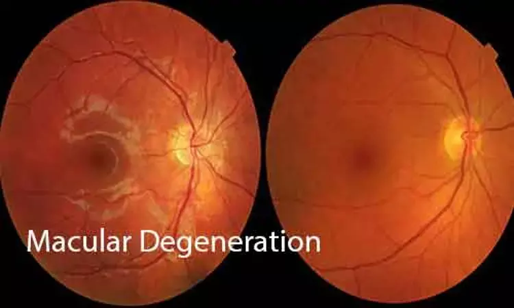 AREDS 5-step Simplified Severity Scale for Macular Degeneration Classification- a Novel Design