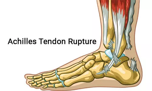 Should surgery be opted for Achilles Tendon rupture? Study says no benefit