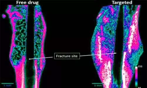 Injectable drug for faster healing of bone fractures ready for trials