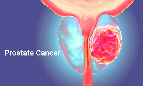 rucaparib-new-treatment-option-for-some-men-with-advanced-prostate-cancer