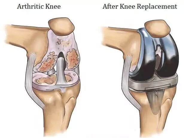 Robotic Knee Replacement tied to Lower Complication Rate upto 3 months after surgery