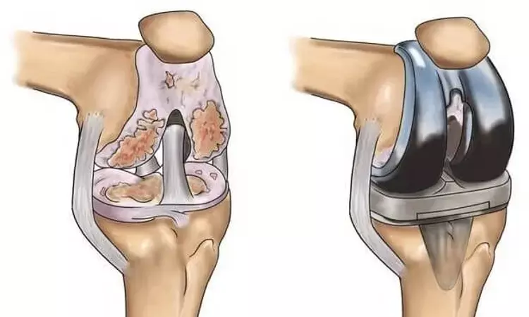 Robotic Knee Replacement tied to Lower Complication Rate upto 3 months after surgery