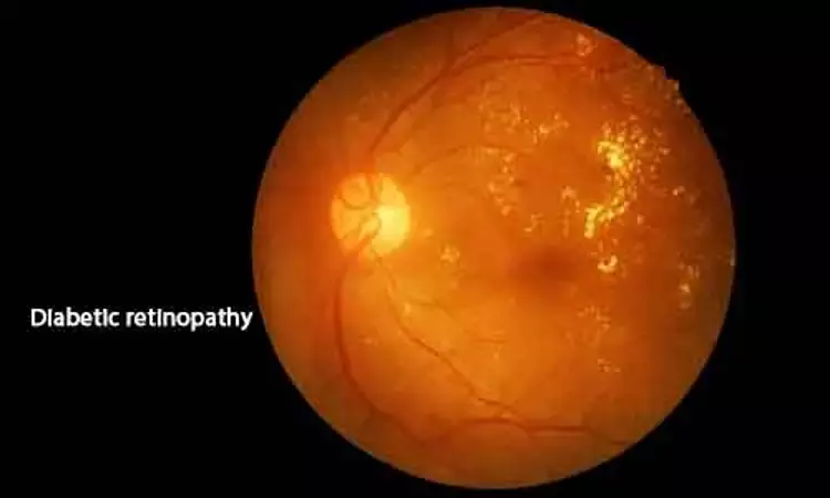 Diabetic retinopathy linked to higher stroke risk in diabetics