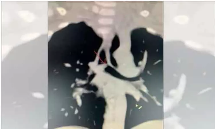 A Nearly Obstructive Intratracheal Mass in a Pediatric Patient: Clinical Challenge