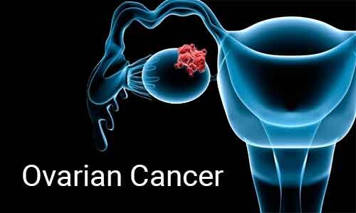 What Blood Test For Ovarian Cancer