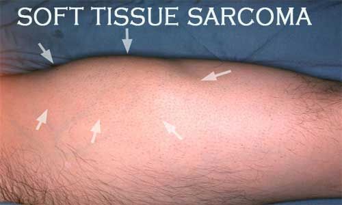 Shorter radiation regimen safe, effective in soft tissue sarcoma