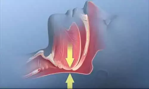 Obstructive sleep apnea and cardiovascular disease: AHA scientific statement