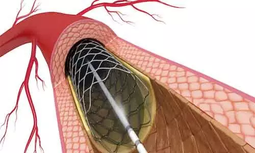 Stent-related adverse events continue to accrue up to 5 years after PCI: JACC