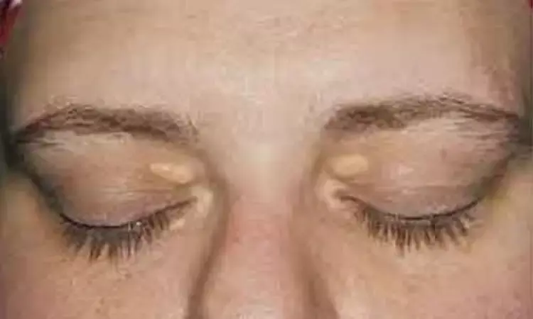 lntradermal heparin sodium cost-effective and less-invasive treatment than CO2 laser for early mild xanthelasma