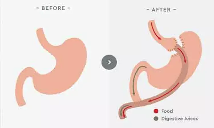 Gastric bypass:  Intraoperative antiemetic agents do not influence postoperative vomiting