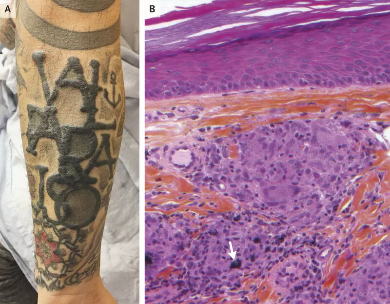 An update on cutaneous complications of permanent tattooing