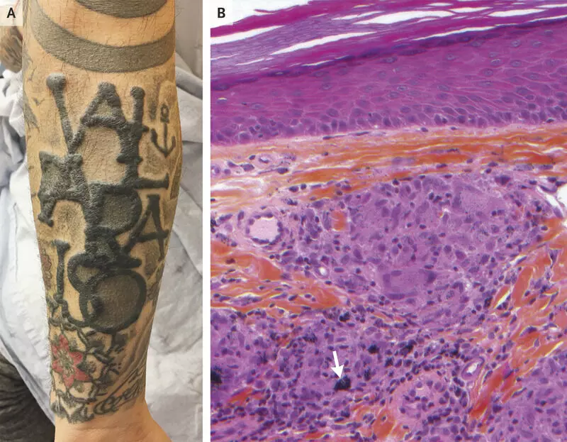 Granulomatous Reactions to Red Tattoo Pigments: A Description of 5 Cases