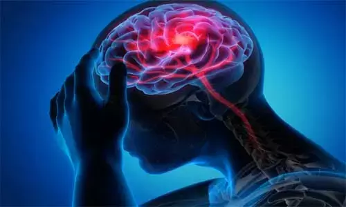 Reperfusion therapy after stroke increases seizures risk regardless of therapy used, finds study