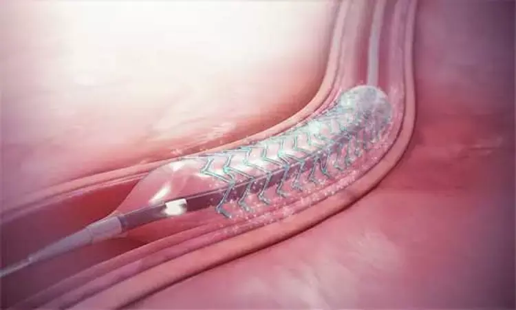 Drug-coated balloon superior to drug-eluting stent for small-vessel CAD: Study