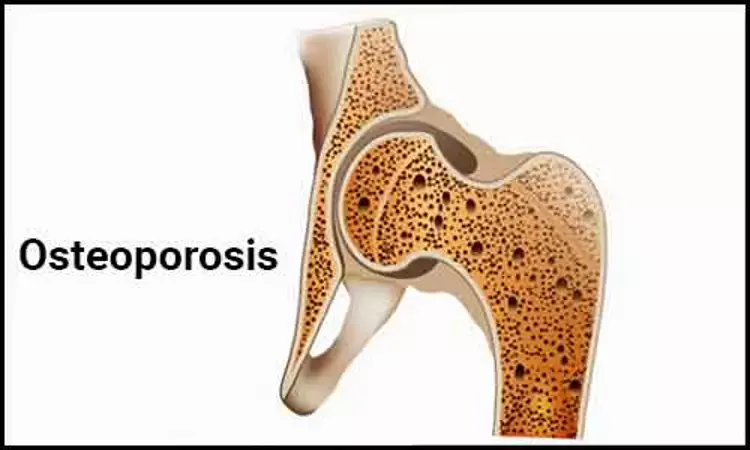 Osteoporosis drug prescribing often does not follow guidelines