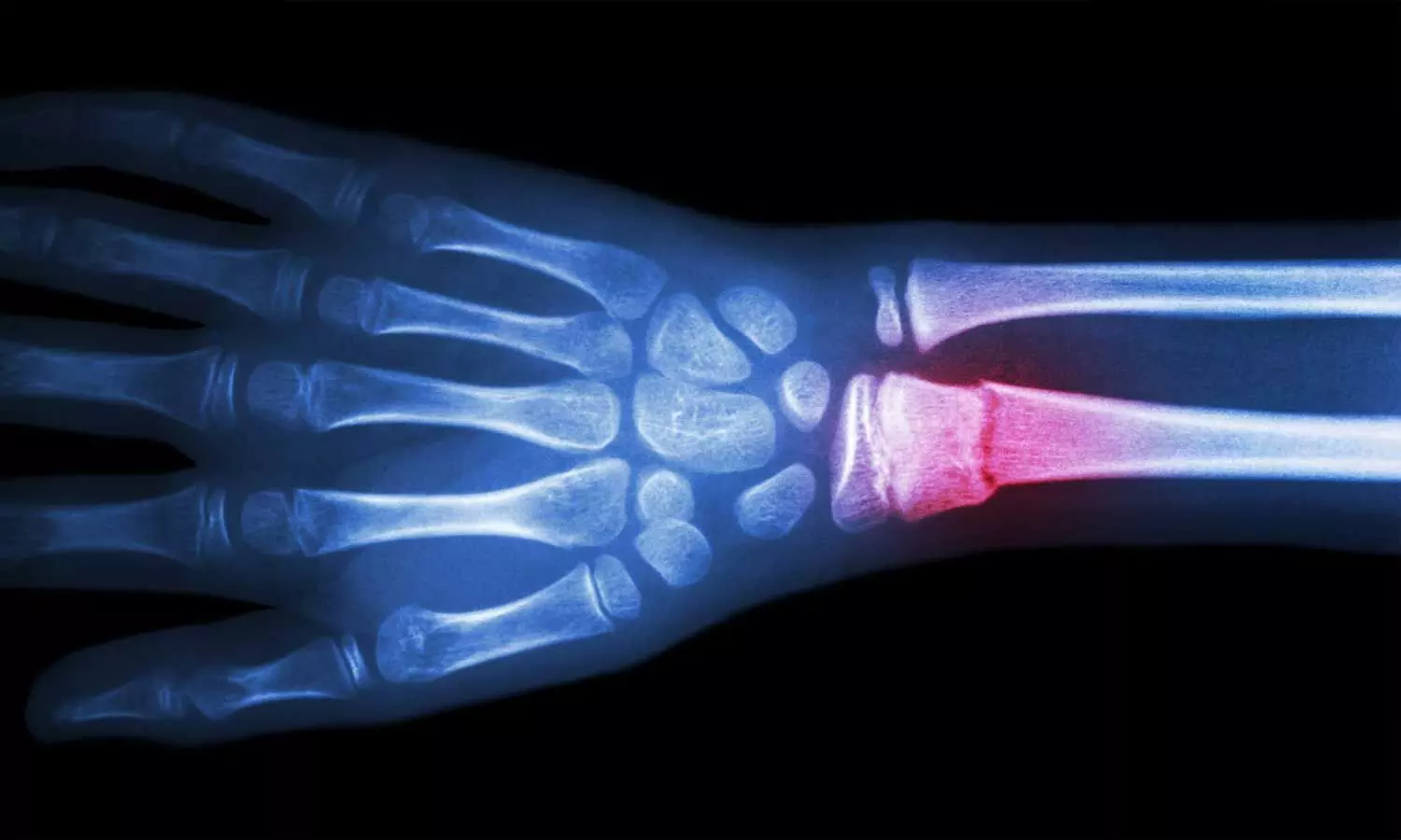 Coupling antibiotics with stem cells may effectively fight bone implant infections