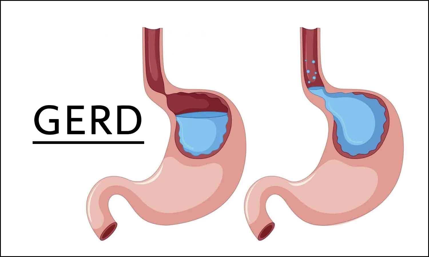 evaluation-and-management-of-gerd-acg-issues-updated-guidelines