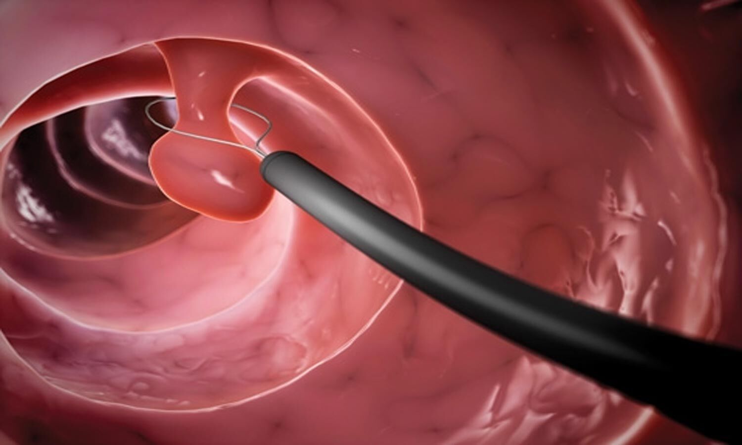 USMSTF Guidelines For Follow Up After Colonoscopy And Polypectomy In 